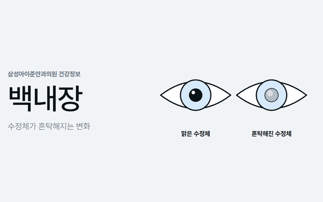 맑은 수정체의 눈과 수정체가 혼탁해진 눈을 나란히 비교한 그림